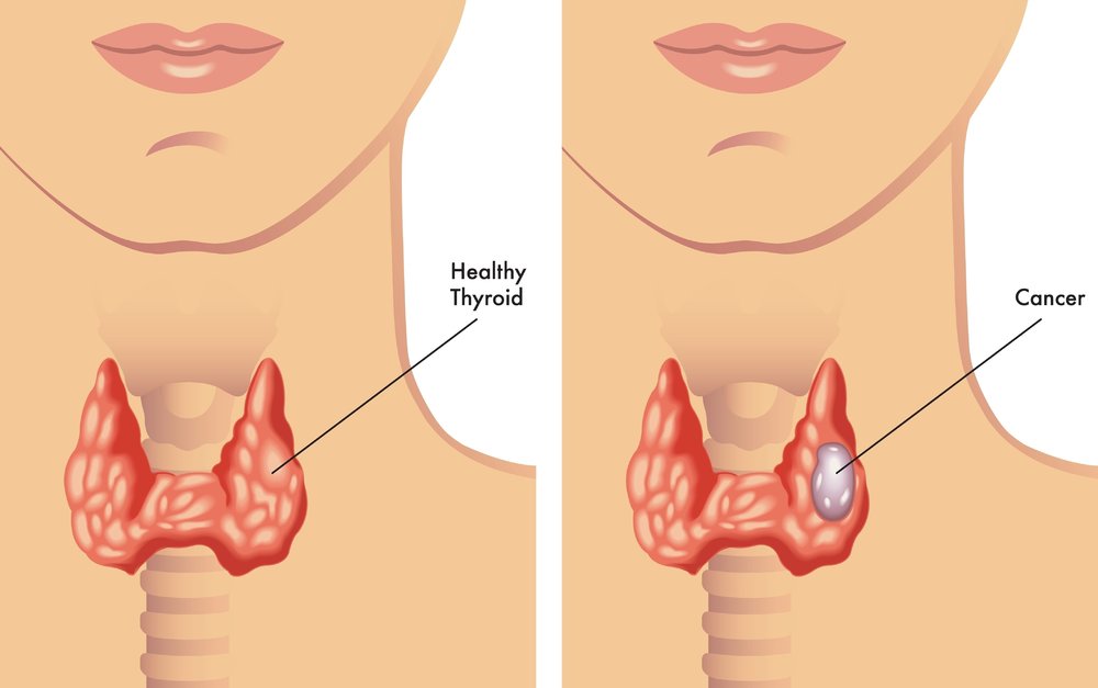 Breast, cervical and thyroid tumor management