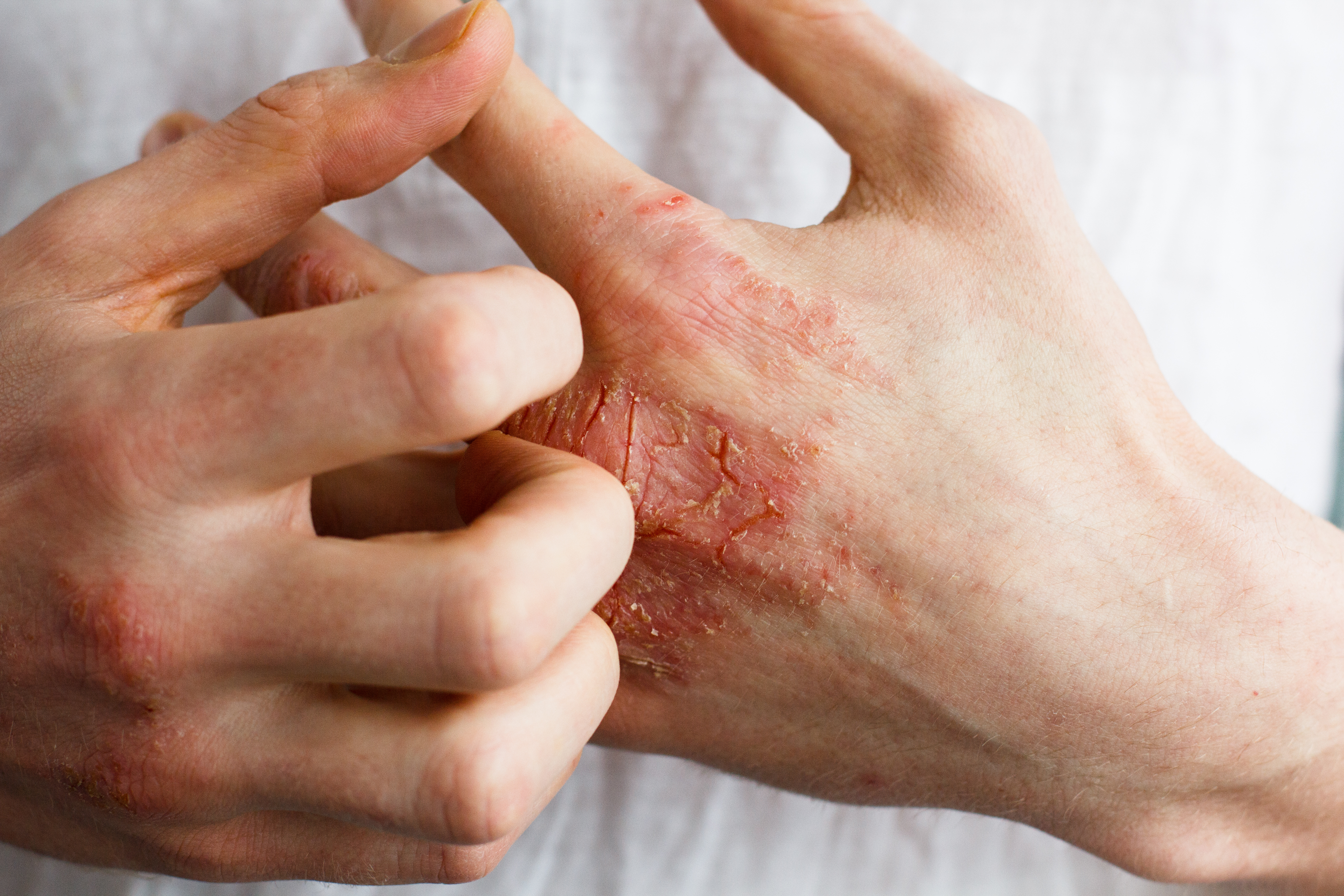 Psoriasis, Eczema, Dark Spots / Hyperpigmentation