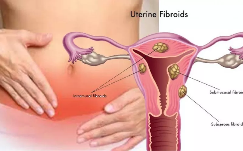 Infertility, menstrual disorders and uterine fibroid treatment